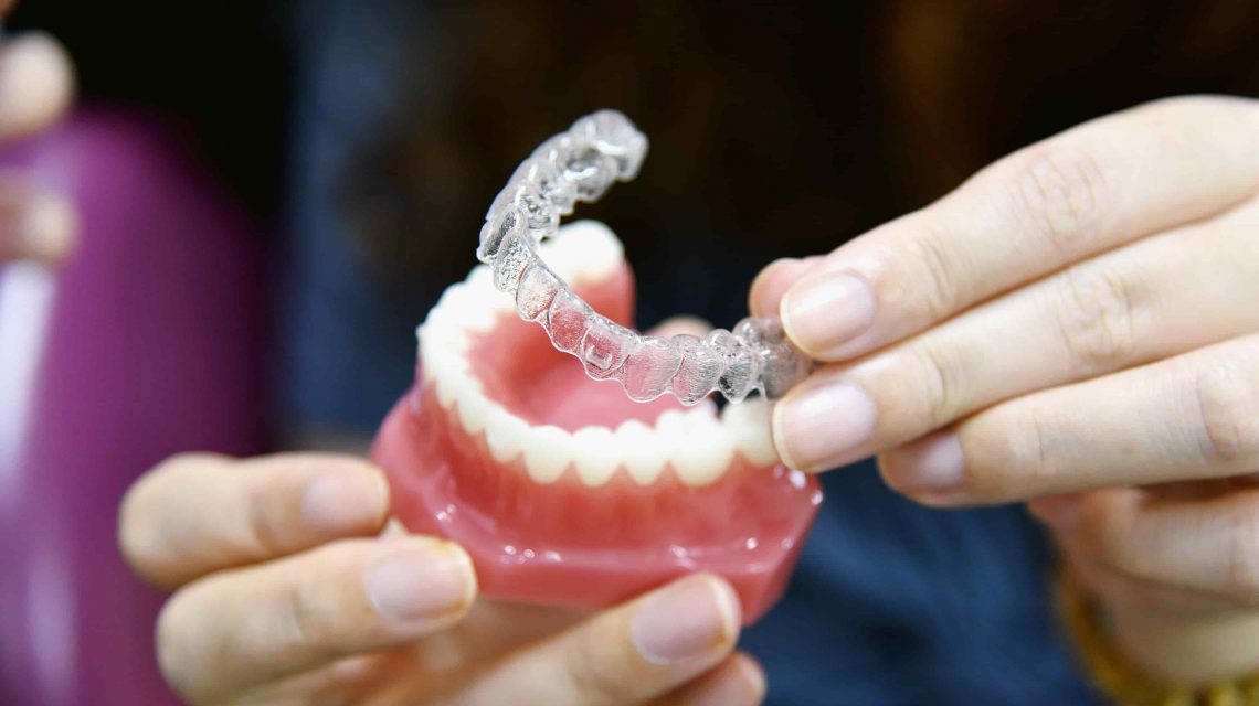 Valor de alinhadores transparentes - Orthoclin