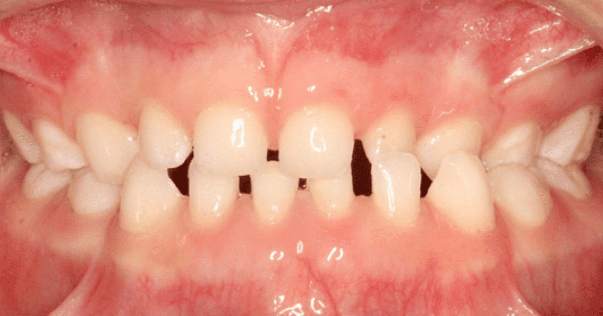 Close de uma mordida aberta destacando problemas ortodônticos em crianças e a necessidade de intervenção.