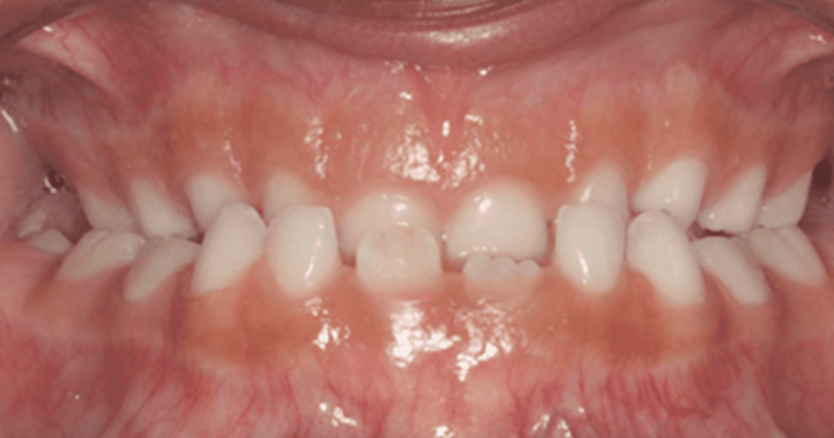 Imagem de dentes desalinhados evidenciando problemas ortodônticos em crianças e os prejuízos à saúde bucal.