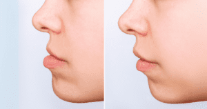 Imagem comparativa de perfil mostrando antes e depois do tratamento de má oclusão dos dentes, com melhora visível no alinhamento facial.