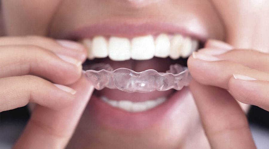 Principais métodos para alinhar os dentes