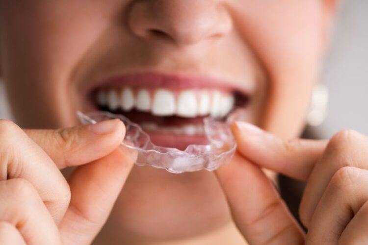 Qual o tempo máximo para usar o alinhador transparente?