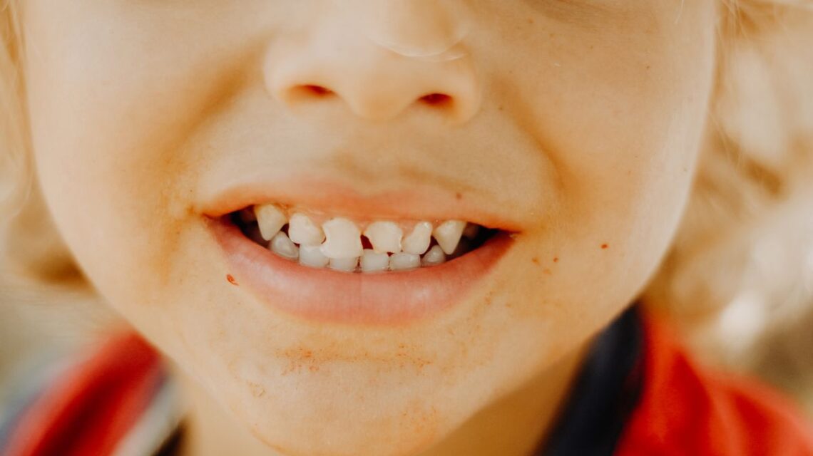 Espaços Entre os Dentes que Incomoda!