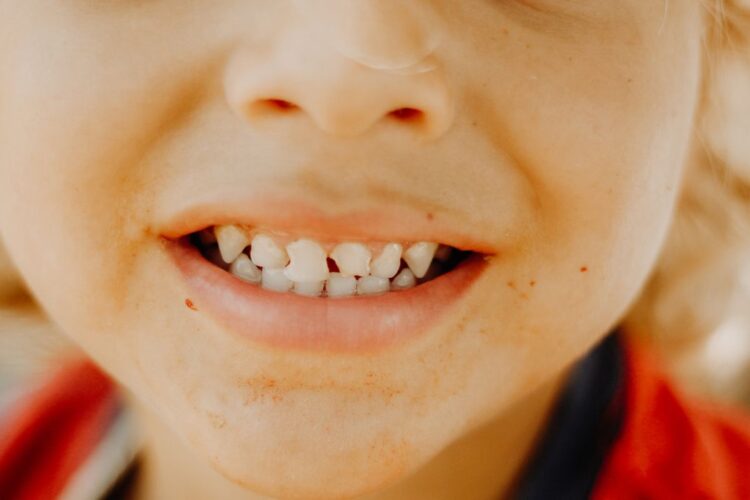 Espaços Entre os Dentes que Incomoda!