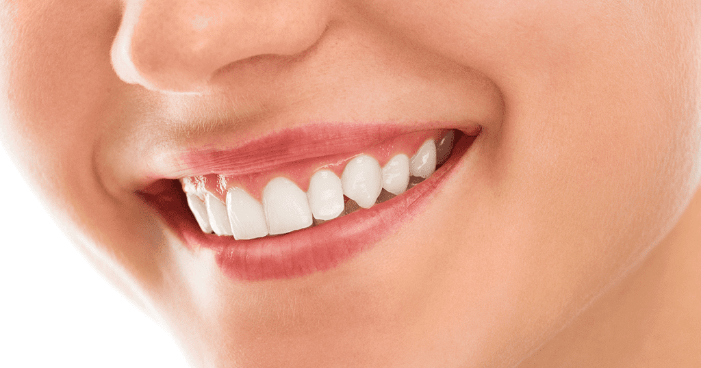 Sorriso de uma pessoa mostrando dentes alinhados, com aparência saudável, resultado do uso de alinhadores transparentes. Saiba mais sobre o valor dos alinhadores transparentes para um tratamento ortodôntico eficaz.