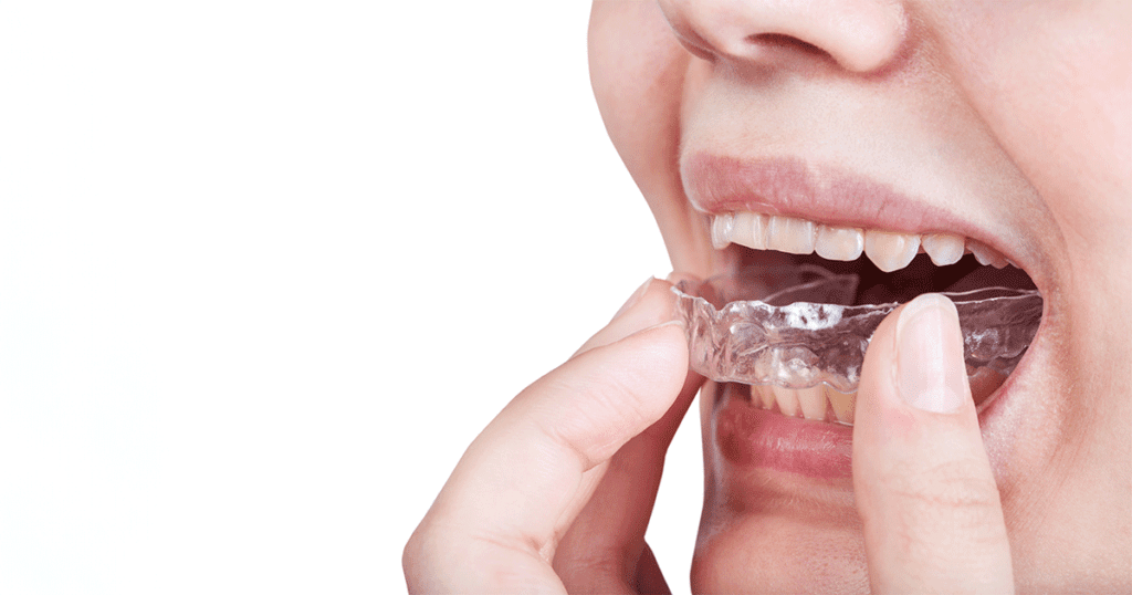 Pessoa colocando alinhadores transparentes nos dentes. O uso desses aparelhos pode ser um tratamento ortodôntico eficaz, com um valor que varia conforme o caso individual.