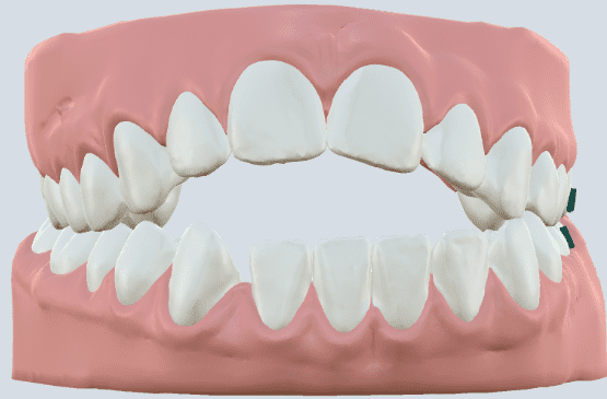 Modelo de mordida aberta ilustrando a diferença entre dentes superiores e inferiores.