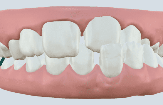 Modelo de mordida cruzada ilustrando a assimetria entre os dentes superiores e inferiores.