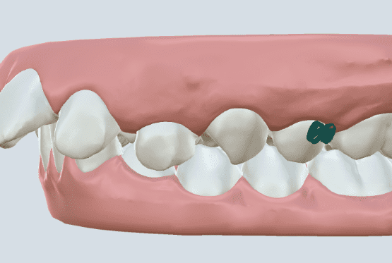 Modelo de mordida profunda mostrando os dentes superiores cobrindo excessivamente os dentes inferiores, uma condição tratável com o tratamento ortodôntico estética.