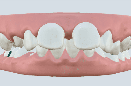Modelo de diastemas mostrando espaços entre os dentes, uma condição corrigível com o tratamento ortodôntico estética.