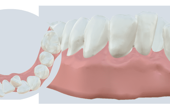 Imagem de apinhamento dentário, onde os dentes estão muito próximos, condição corrigível com tratamento ortodôntico estética.