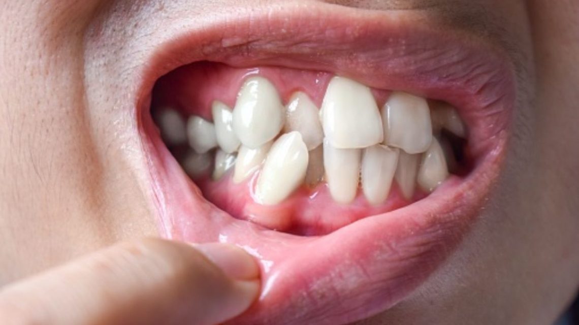 Dentes Apinhados