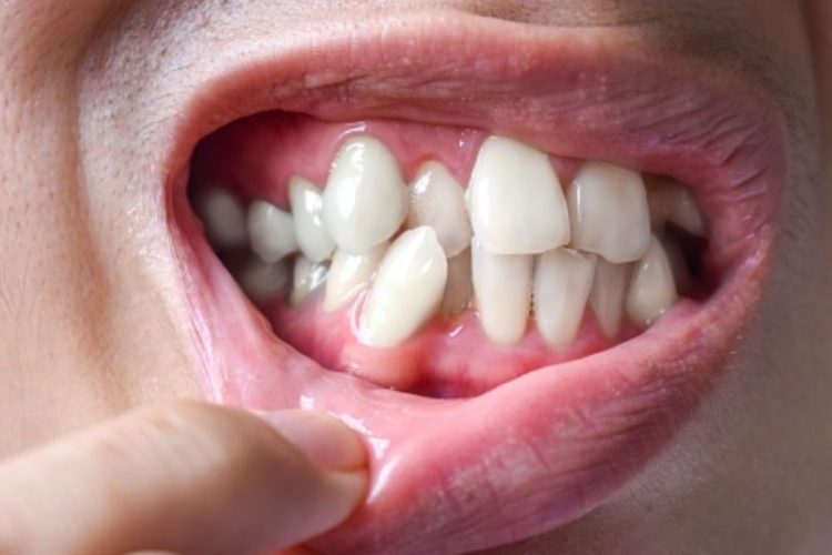 Dentes Apinhados