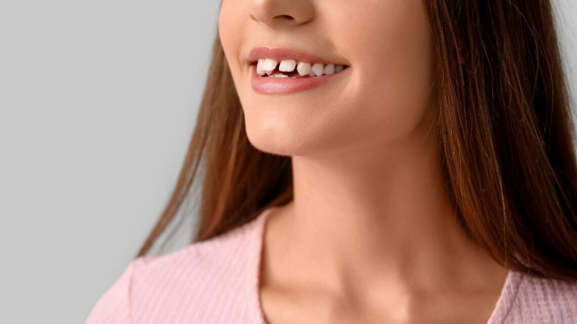 Diastema