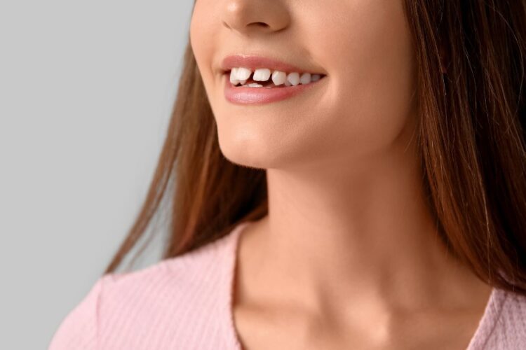 Diastema