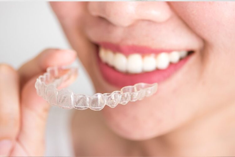 4 Benefícios do uso de alinahdores transparentes no tratamento ortodôntico