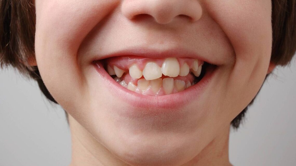 Consequência dos dentes tortos ou apinhados para saúde