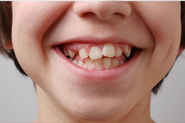 Consequência dos dentes tortos ou apinhados para saúde