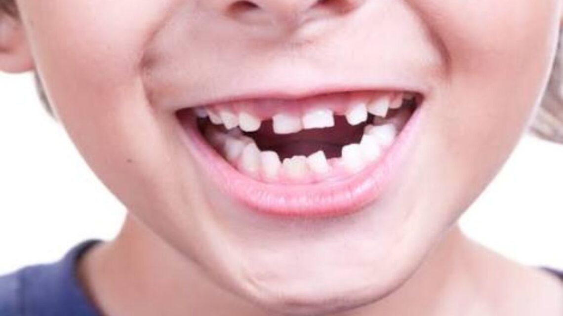 O que fazer quando o dentes permanentes estão nascendo torto
