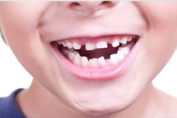 O que fazer quando o dentes permanentes estão nascendo torto
