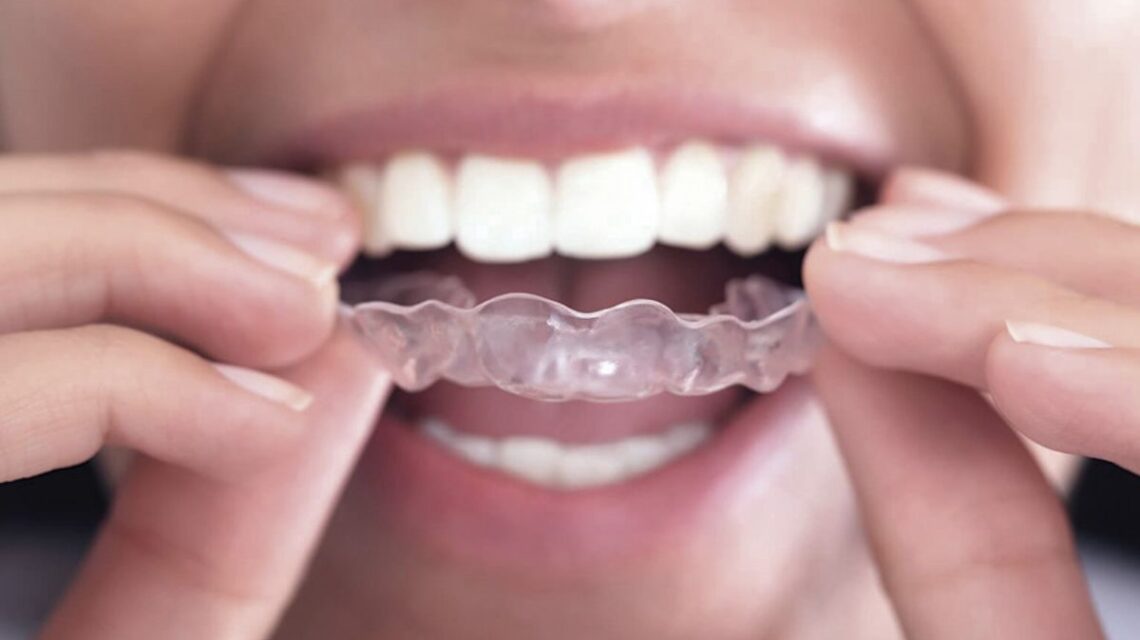 Qual o melhor tratamento para ter dentes alinhados?