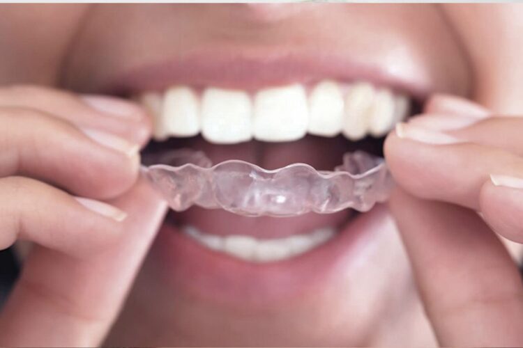 Qual o melhor tratamento para ter dentes alinhados?