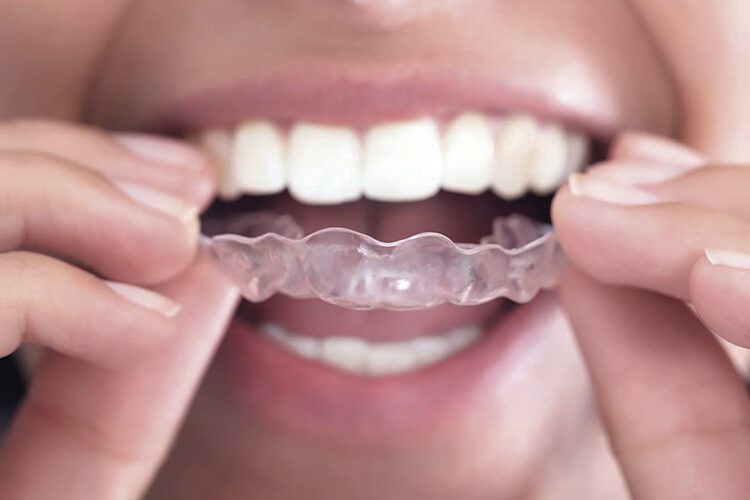 Principais métodos para alinhar os dentes