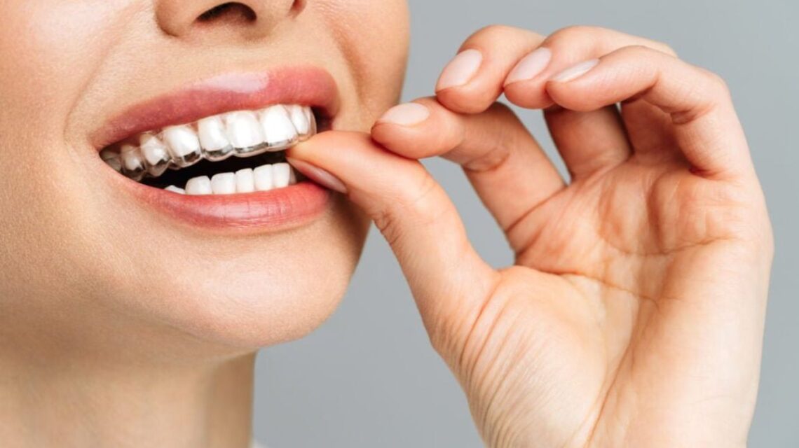 O benefício estético dos alinhadores e como alinhar o sorriso sem mudar sua rotina