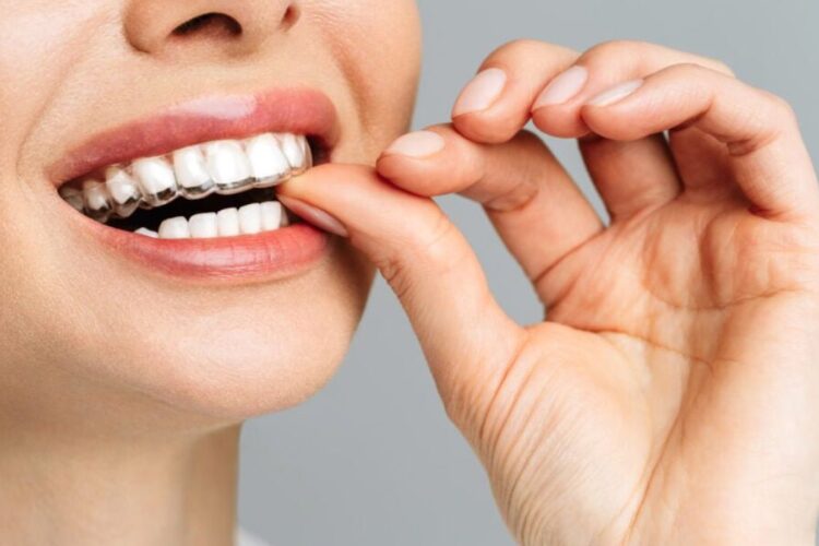O benefício estético dos alinhadores e como alinhar o sorriso sem mudar sua rotina